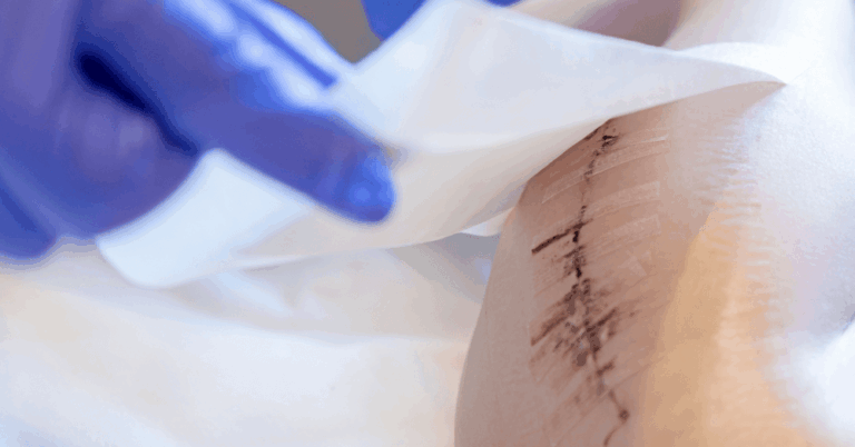 A Healing Debate: Scar Tape or Scar Gel—What Works Best?